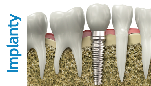 Zaawansowane technologicznie implanty dentystyczne, przywracające naturalny uśmiech.